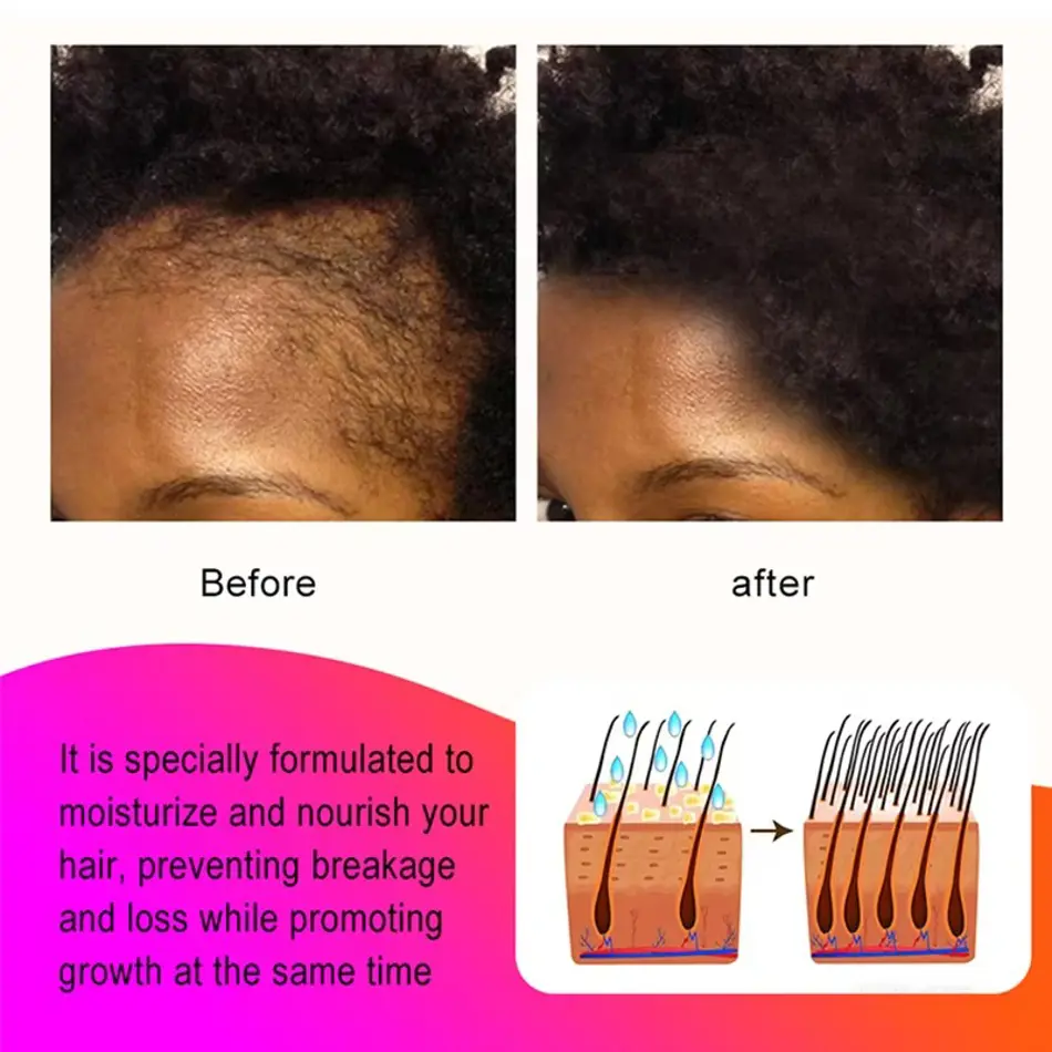 Sevich Chebe Hair Butter Mask – 100g Leave-In Treatment for Traction Alopecia & Damaged Hair | Moisturizes & Strengthens Roots